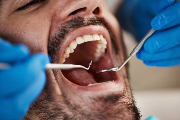 Best Emergency Dental Extractions in Dallas, TX